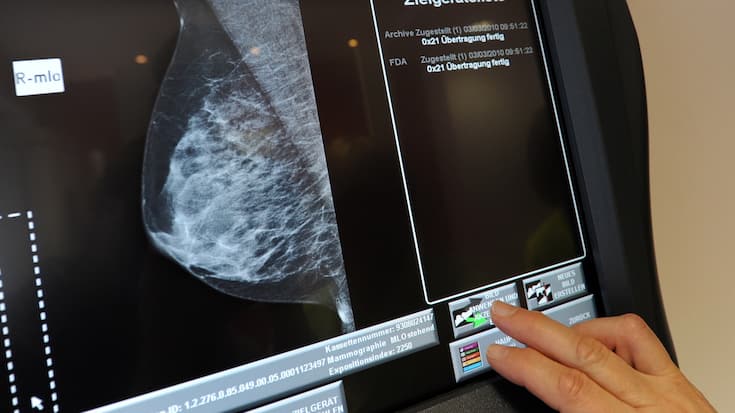 DEUTSCHLAND TEILNAHMEQUOTE BEIM MAMMOGRAFIE-SCREENING SINKT