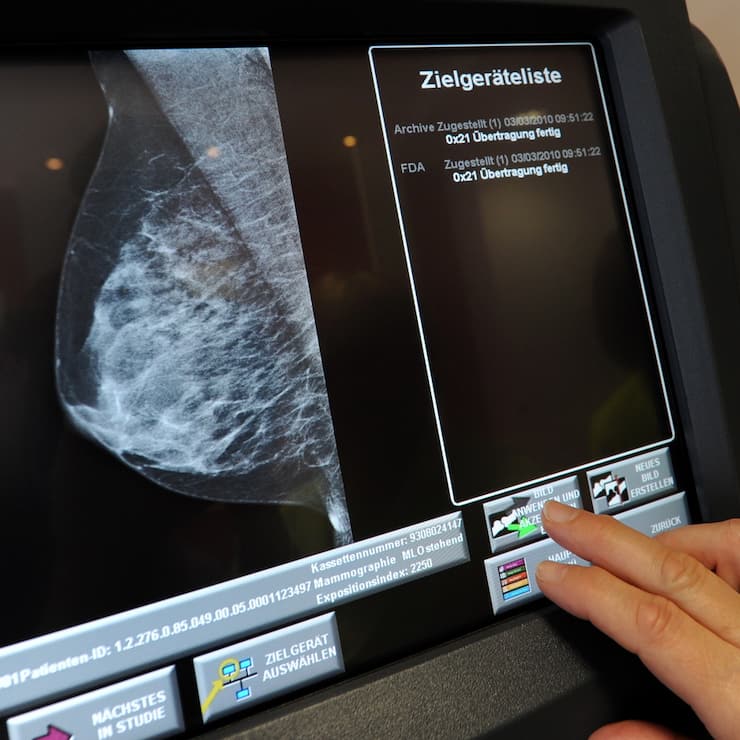 DEUTSCHLAND TEILNAHMEQUOTE BEIM MAMMOGRAFIE-SCREENING SINKT