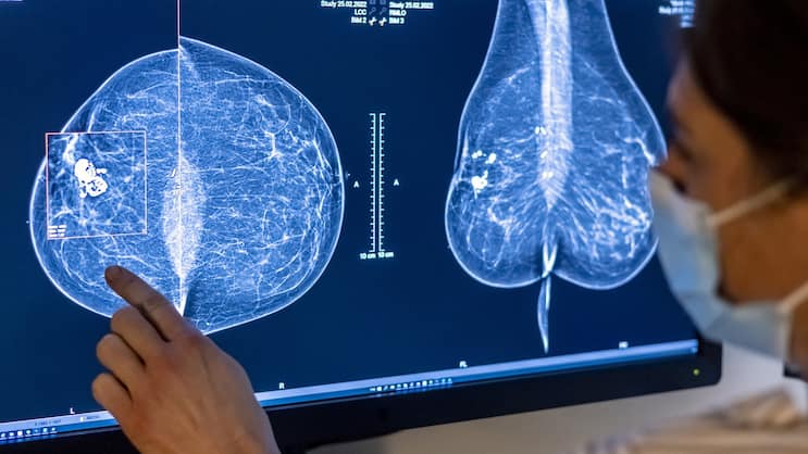 En 2022, les maladies non transmissibles telles que le cancer ont engendré des coûts de 65,7 milliards de francs: examen des seins d'une femme à la recherche d'un cancer du sein par mammographie.